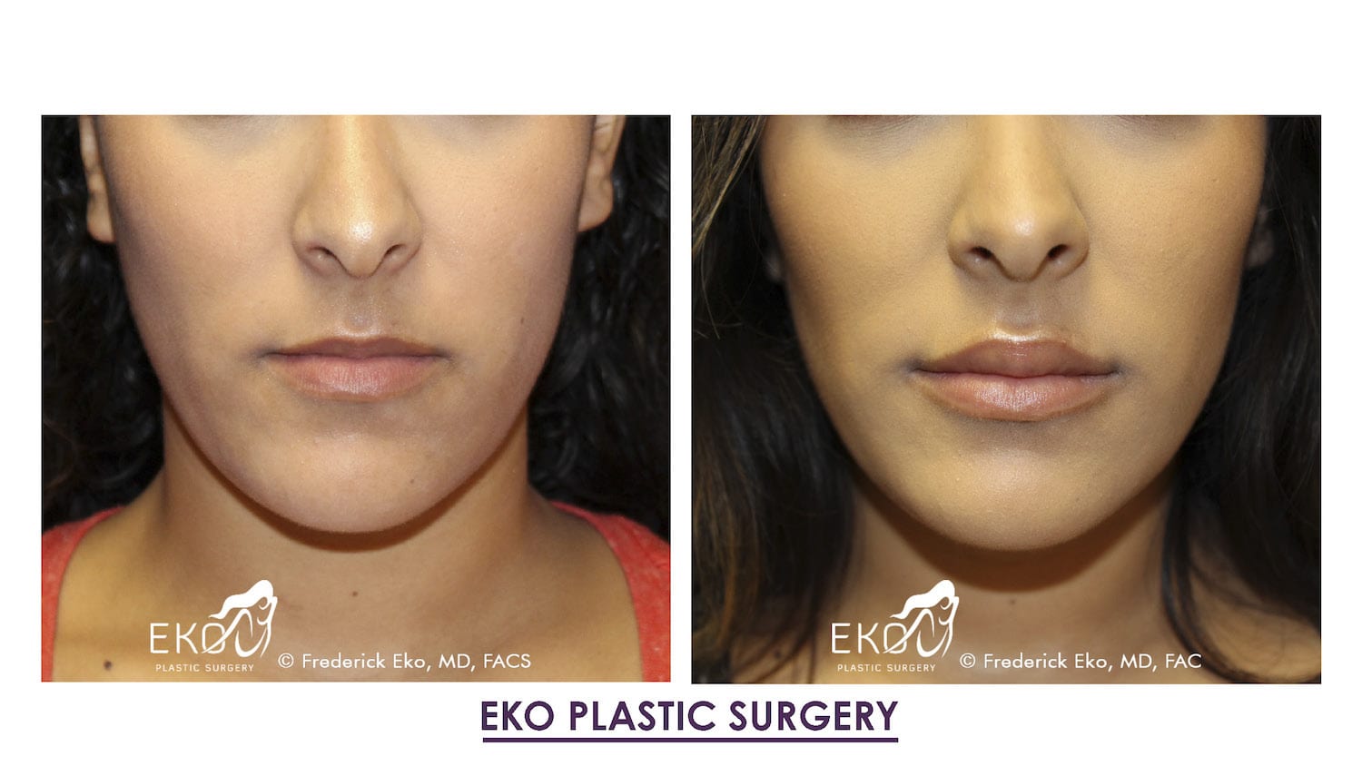Juvederm Before and After Photo by Dr. Eko of Eko Plastic Surgery in Palm Desert, CA
