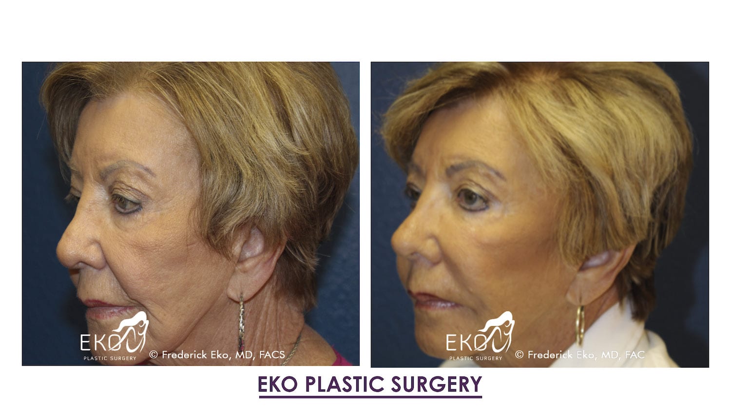 Juvederm Before and After Photo by Dr. Eko of Eko Plastic Surgery in Palm Desert, CA