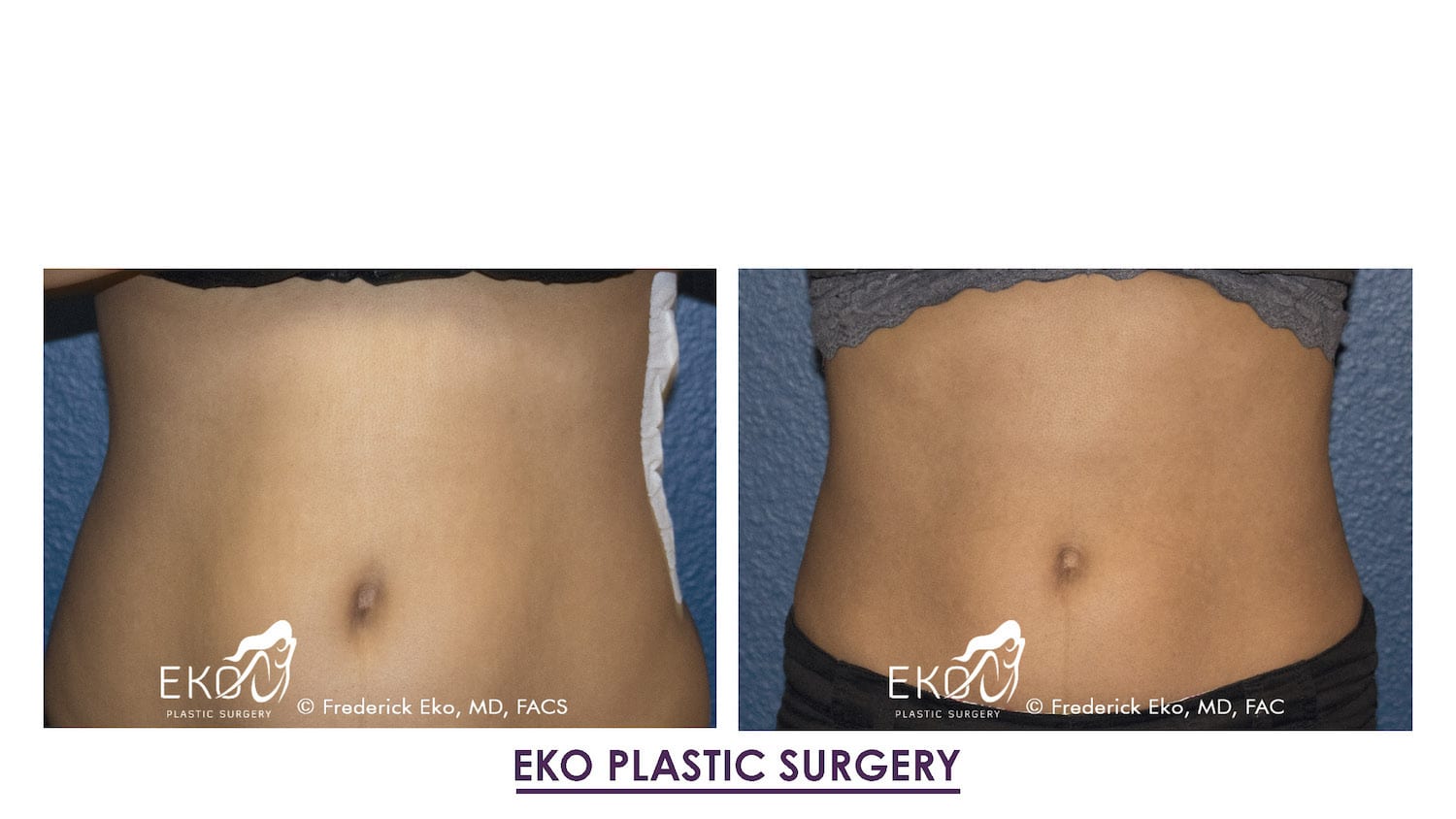 CoolSculpting® Before and After Photo by Dr. Eko of Eko Plastic Surgery in Palm Desert, CA