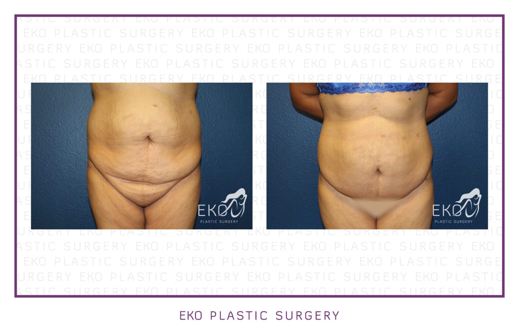 Panniculectomy Before and After Photo by Dr. Eko of Eko Plastic Surgery in Palm Desert, CA