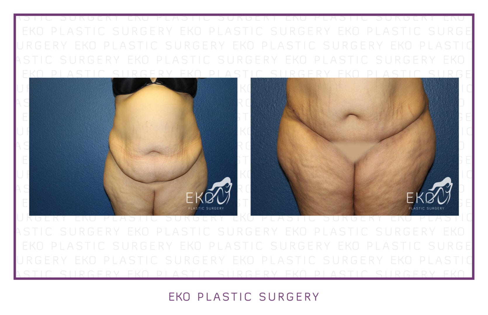 Panniculectomy Before and After Photo by Dr. Eko of Eko Plastic Surgery in Palm Desert, CA