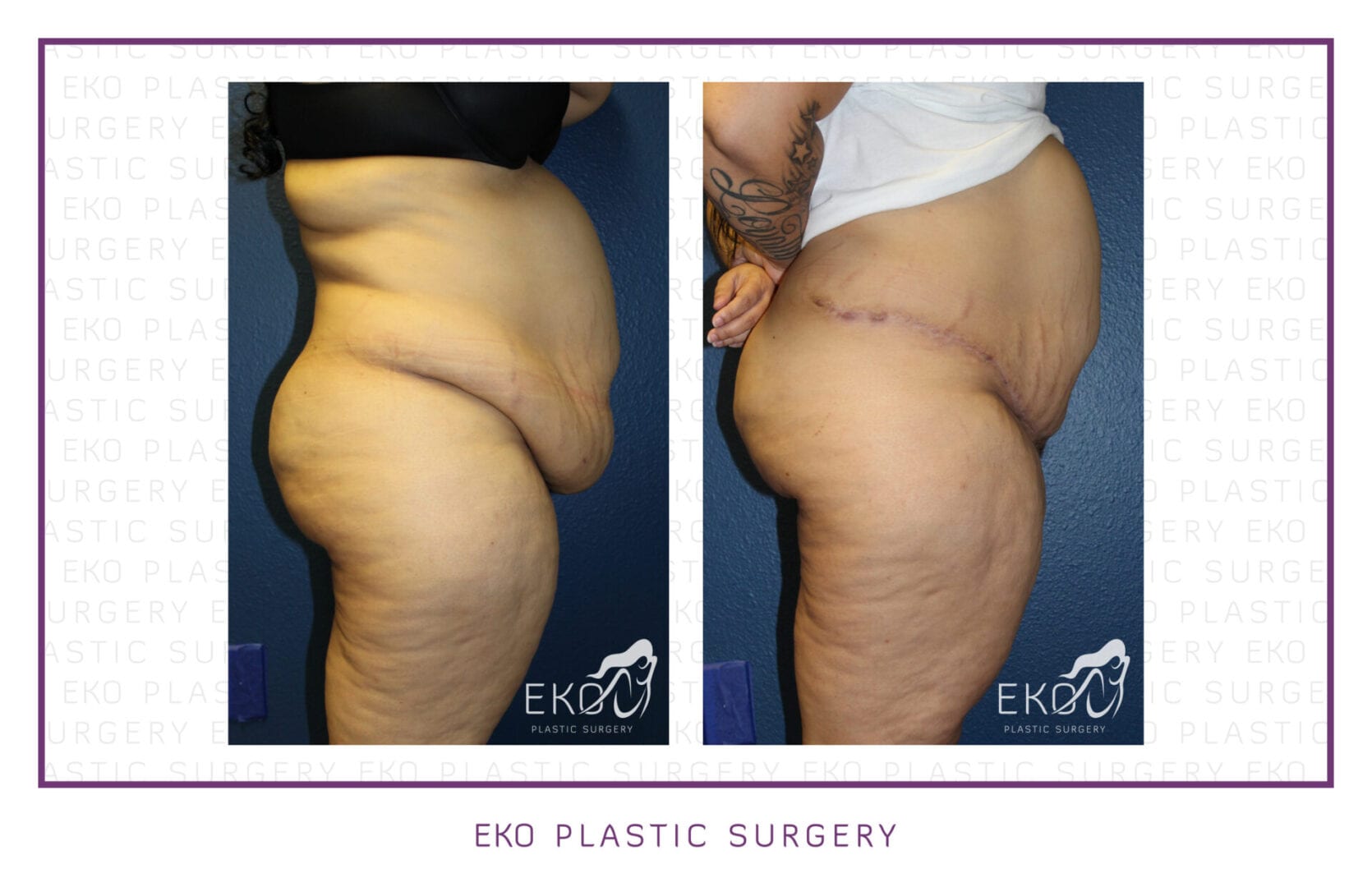 Panniculectomy Before and After Photo by Dr. Eko of Eko Plastic Surgery in Palm Desert, CA