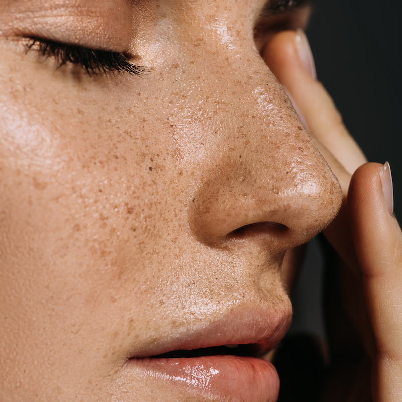 Rhinoplasty up-close image of woman's freckled nose