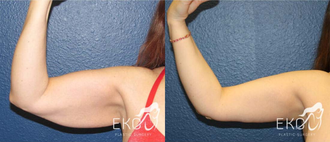 Arm Lift Before and After Photo by Dr. Eko of Eko Plastic Surgery in Palm Desert, CA
