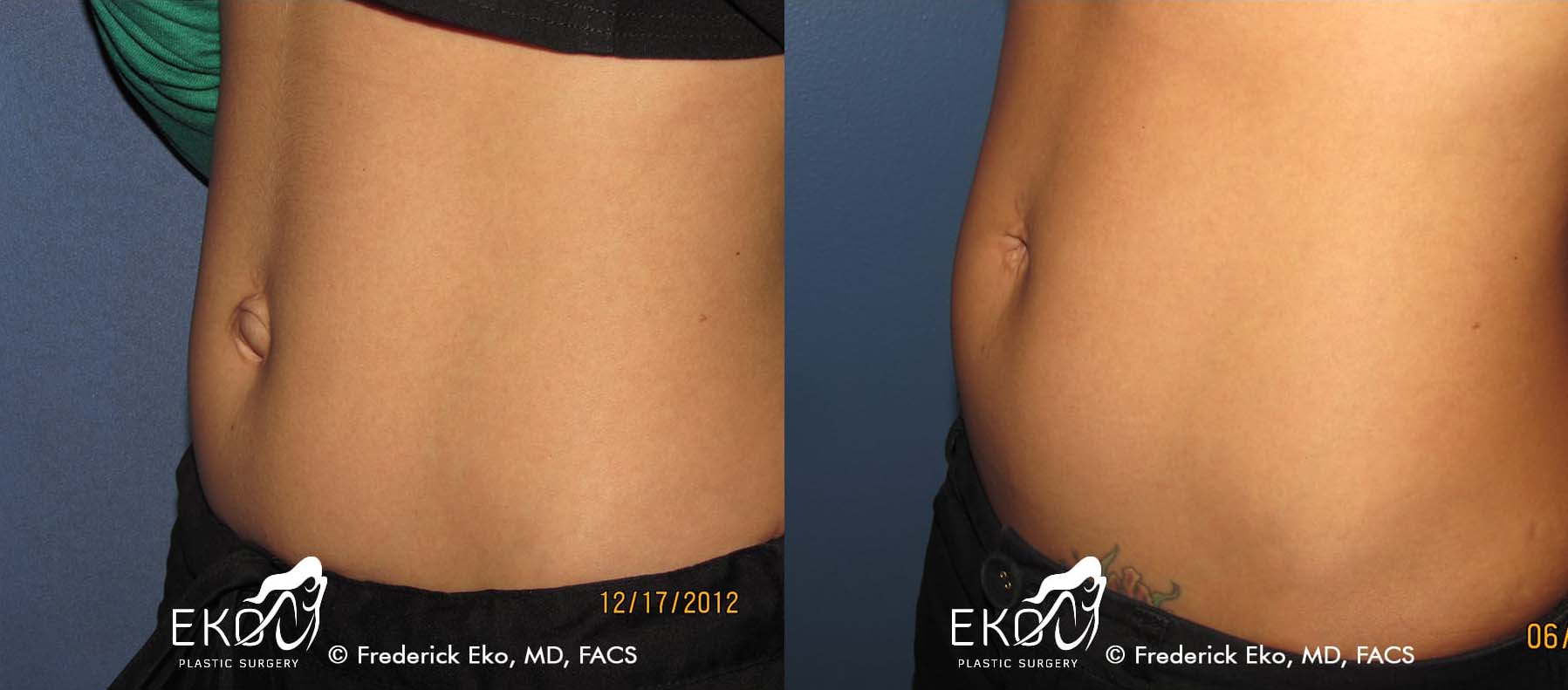 Belly Button Surgery (Umbilicoplasty) Before and After Photo by Dr. Eko of Eko Plastic Surgery in Palm Desert, CA
