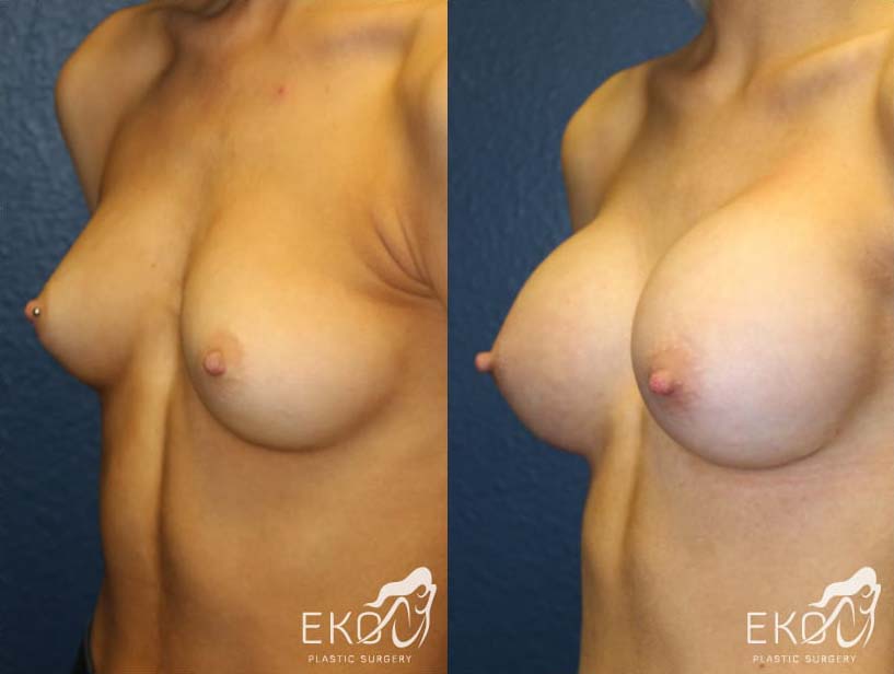 Breast Augmentation Before and After Photo by Dr. Eko of Eko Plastic Surgery in Palm Desert, CA