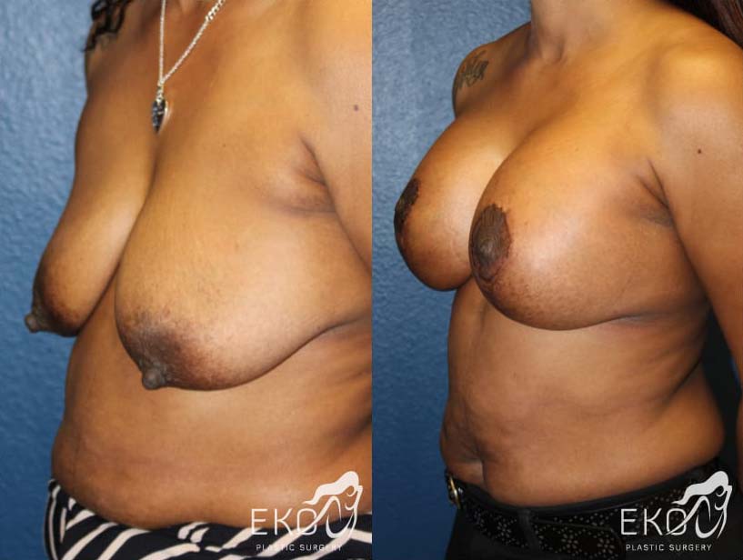 Breast Lift Before and After Photo by Dr. Eko of Eko Plastic Surgery in Palm Desert, CA