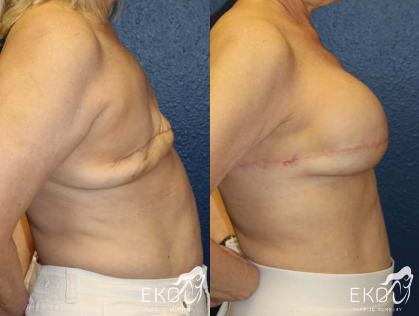 Breast Reconstruction Before and After Photo by Dr. Eko of Eko Plastic Surgery in Palm Desert, CA