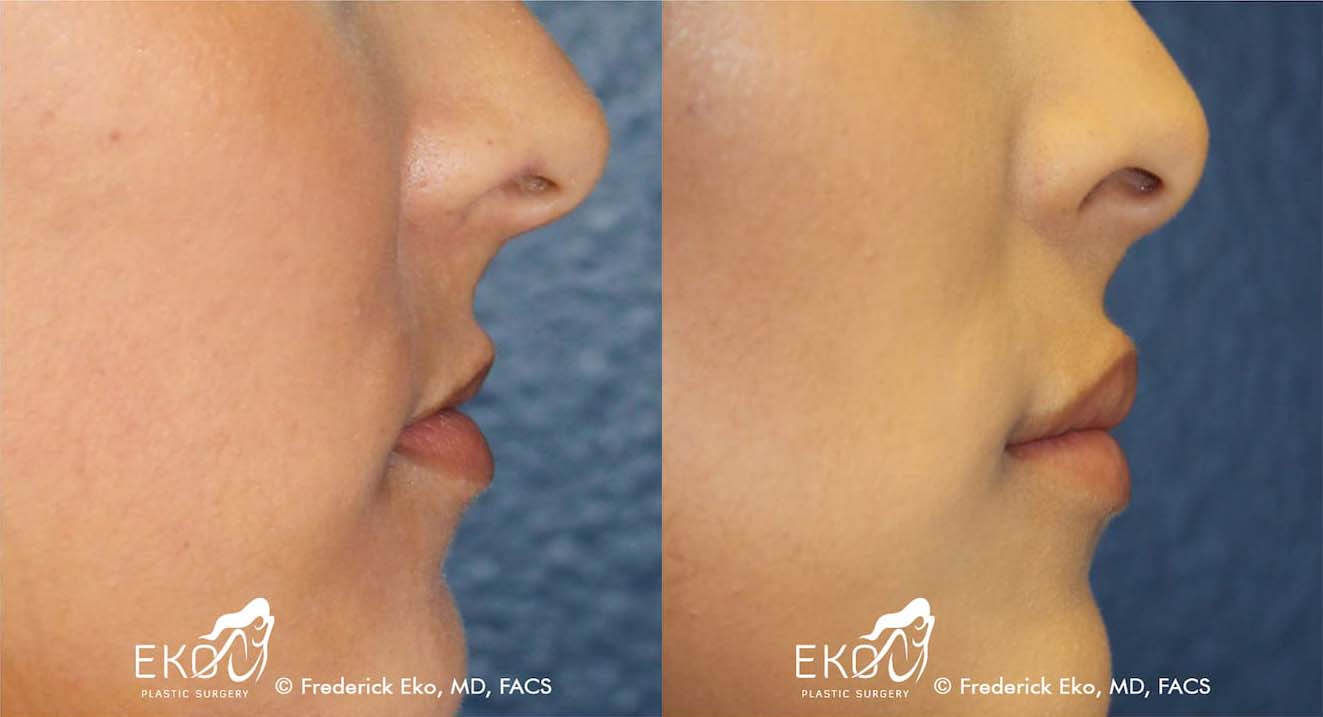 Juvederm Before and After Photo by Dr. Eko of Eko Plastic Surgery in Palm Desert, CA