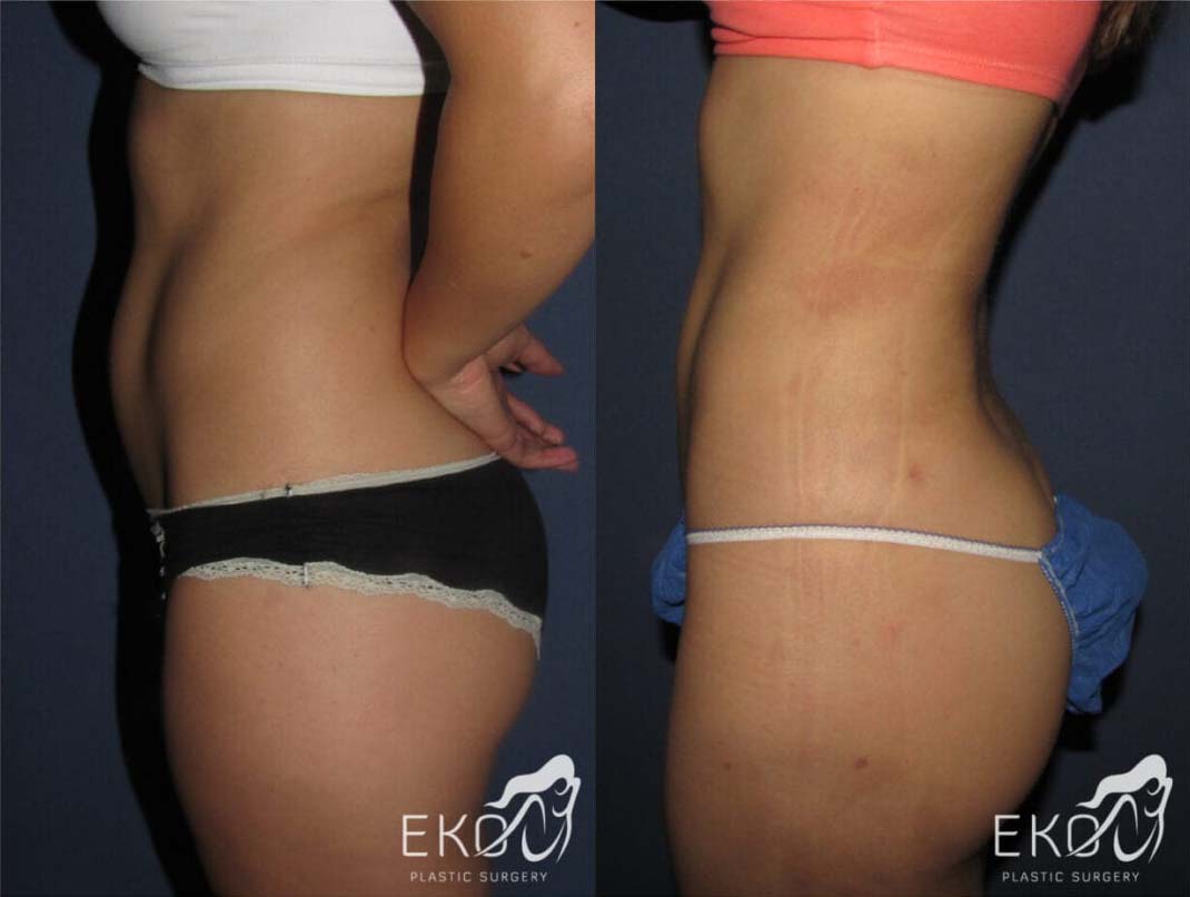 Liposuction Before and After Photo by Dr. Eko of Eko Plastic Surgery in Palm Desert, CA