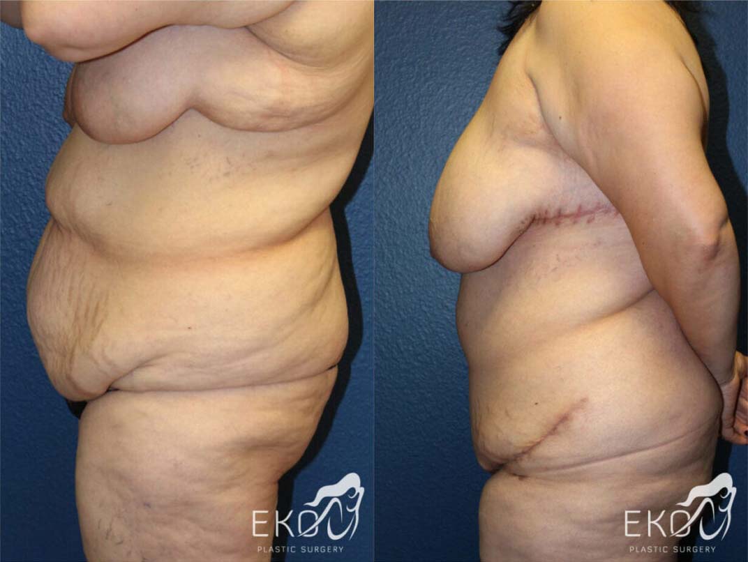 Post Weight Loss Procedures Before and After Photo by Dr. Eko of Eko Plastic Surgery in Palm Desert, CA