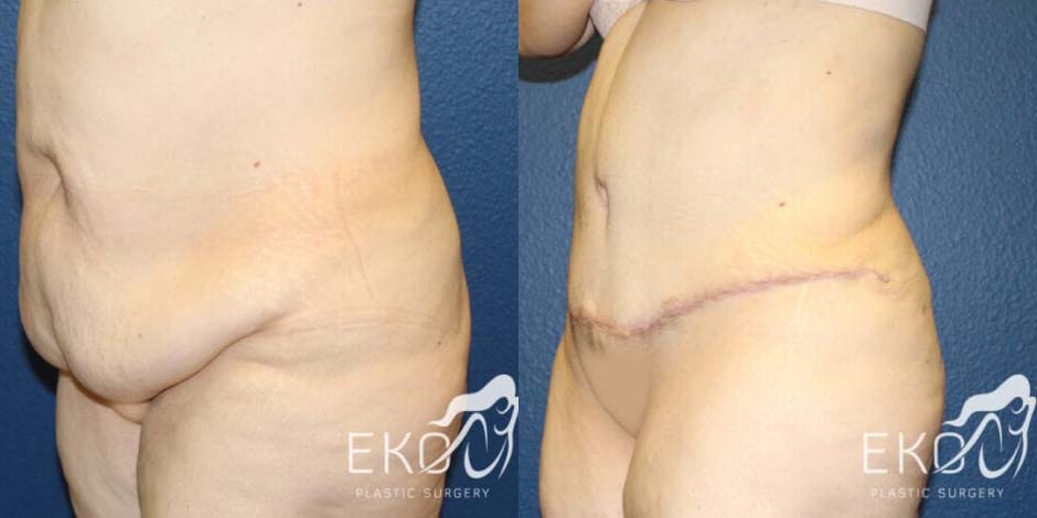 Tummy Tuck Before and After Photo by Dr. Eko of Eko Plastic Surgery in Palm Desert, CA